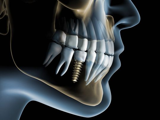 Implantologie - Zahnarzt Dr. med. dent. A. Pastori - Bassersdorf